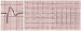 Abb. 1: Brugada-Syndrom