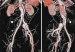 Abb. 1: Iliaca-Aneurysma
