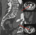 Aktuelles Bild - Abb. 2: Iliaca-Aneurysma