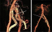 Abb. 4: Iliaca-Aneurysma