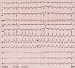 Aktuelles Bild - Abb. 1: EKG