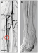 Aktuelles Bild - Abb. 1a-b: Verschluss der ATP