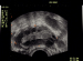 Abb. 2: PCOS