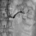 Aktuelles Bild - Abb. 1: Nierenarterienstenose