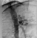 Abb. 2b: Stent