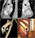 Aktuelles Bild - Abb. 1A-D: Coronary artery