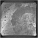 Abb. 1: Catheter-Induced Dissection