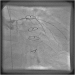 Abb. 3: Catheter-Induced Dissection