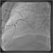 Aktuelles Bild - Abb. 4: Catheter-Induced Dissection