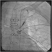 Abb. 7: Catheter-Induced Dissection
