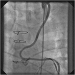 Abb. 8: Catheter-Induced Dissection