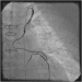 Abb. 9: Catheter-Induced Dissection