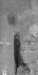 Abb. 1: Venöses Stenting