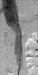 Abb. 3: Venöses Stenting