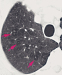 Abb. 1: Computertomographie-COPD