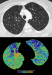 Abb. 2: Computertomographie-COPD