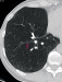 Abb. 3: Computertomographie-COPD