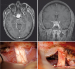 This Image - Fig. 1: Intracranial Meningioma