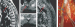 Fig. 1a-e: Spinal Meningioma