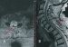 This Image - Fig. 2: Spinal Menigioma