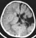This Image - Fig. 1: Brain-Collision-Tumour