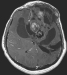 Fig. 2: Brain-Collision-Tumour