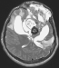 Fig. 3: Brain-Collision-Tumour