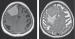This Image - Fig. 1: Meningeoma