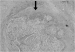 Fig. 2: Nerve-Infiltration