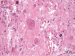 Fig. 7: Brain-Collision-Tumour