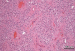 Fig. 8: Brain-Collision-Tumour