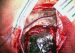 This Image - Fig. 1: Leptomeningeal Tumour