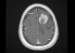 Fig. 2: Leptomeningeal Tumour
