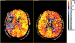 Abb. 1: Schlaganfall-Neuroimaging