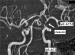 Abb. 2: Hypophysenadenom