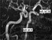 Abb. 7: Hypophysenadenom