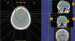 This Image - Fig. 1: Radiotherapy - Meningioma