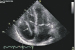 This Image - Fig. 1: Transthoracic echocardiogram