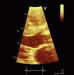 Abb. 3: LVOT