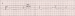 Aktuelles Bild - Abb. 1: Bradyarrhythmie