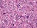 Abb. 1: Pleomorphes Sarkom