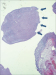 Aktuelles Bild - Abb. 2: Submukosaler Tumor