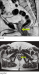 Abb. 4: Submukosaler Tumor