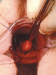 Abb. 5: Submukosaler Tumor