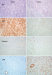 Abb. 7: Submukosaler Tumor