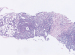 Abb. 4a: Follikuläres Lymphom