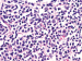 Abb. 4b: Follikuläres Lymphom