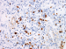 Abb. 4d: Follikuläres Lymphom