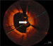 Abb. 9: Thrombus - In-Stent-Restenose