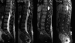 Fig. 1: Spinal Teratoma